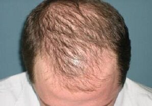 příčiny vypadávání vlasů