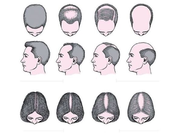 Androgenetická alopecie u mužů a žen