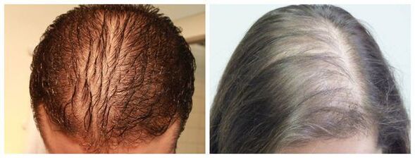 Difuzní alopecie