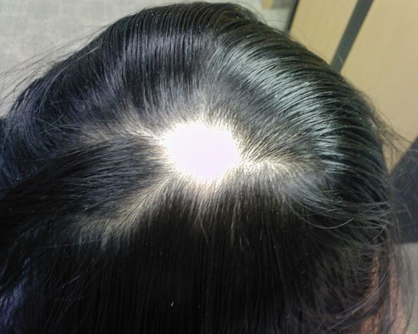 Alopecia areata nebo alopecia areata u žen