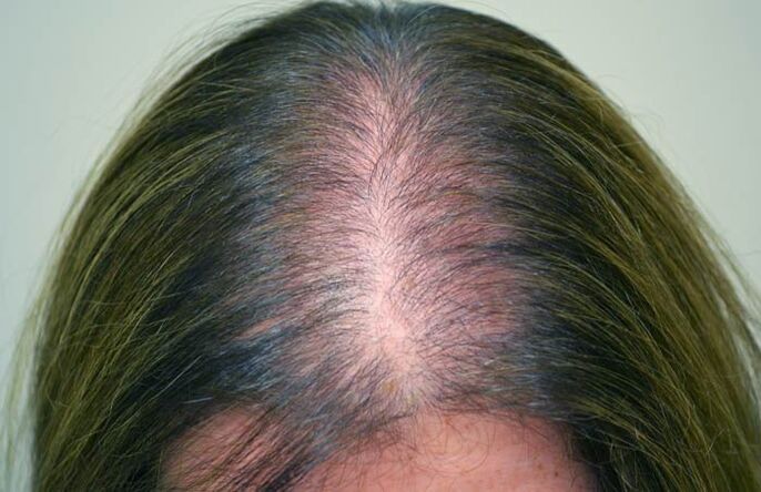 Alopecie (plešatost) u žen