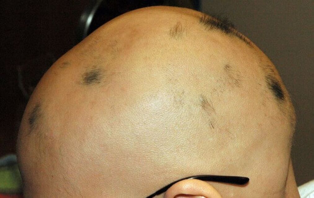 celková alopecie pokožky hlavy u muže