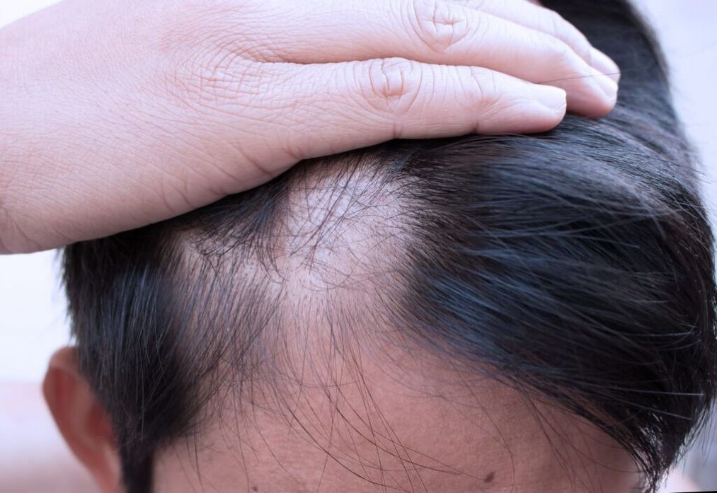 difuzní alopecie hlavy