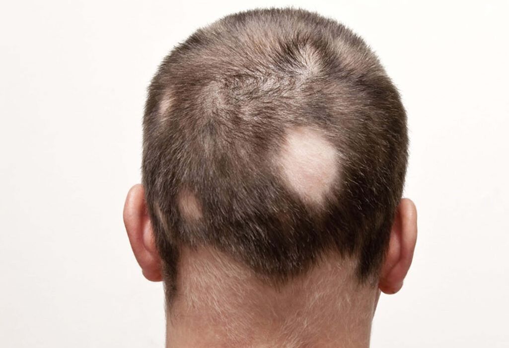 hnízdící (fokální) alopecie hlavy