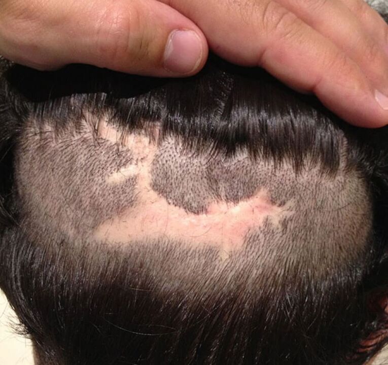 jizevnatá alopecie pokožky hlavy