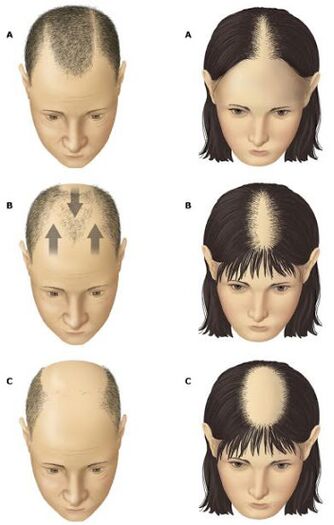 Androgenní alopecie u mužů a žen