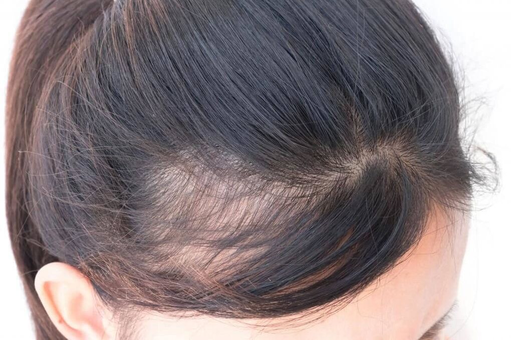 Androgenní alopecie u žen