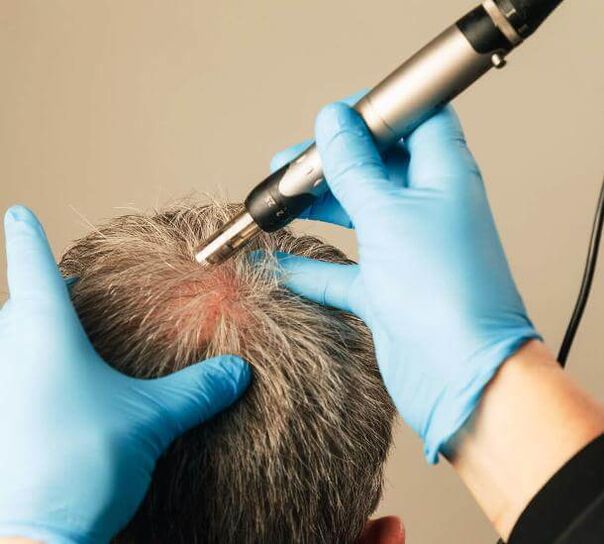 Fyzioterapie pro léčbu androgenní alopecie