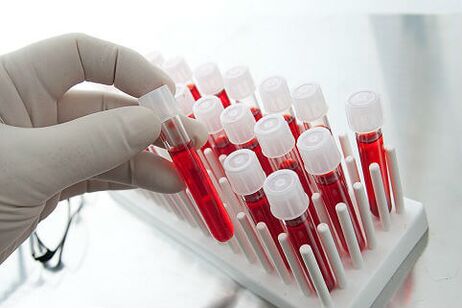Krevní test k předepsání individuální léčby alopecie