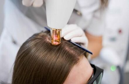 Laserová terapie androgenní alopecie