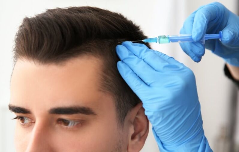 Mezoterapie ke stimulaci růstu vlasů u androgenní alopecie